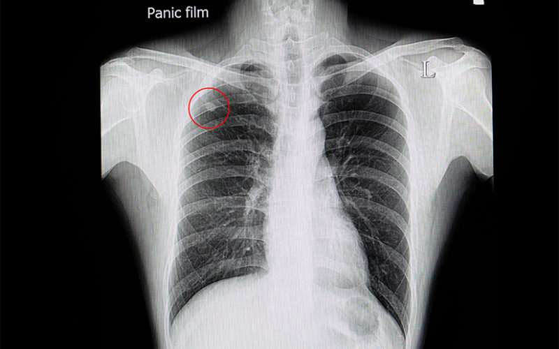 Covid-19 poate cauza anomalii la nivelul plămânilor detectabile după mai mult de trei luni de când pacientul a fost infectat