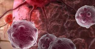 Un test „revoluţionar” ar putea detecta riscul de a dezvolta patru tipuri de cancer la femei
