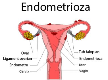 10% dintre femeile din România suferă de endometrioză