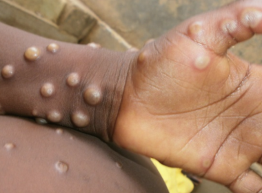 Italia a început vaccinarea împotriva variolei maimuţei