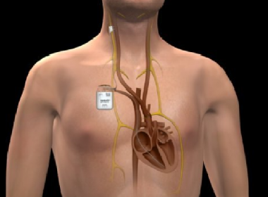 Caracatiţa stimulatoarelor cardiace