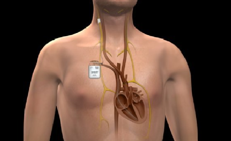 Caracatiţa stimulatoarelor cardiace
